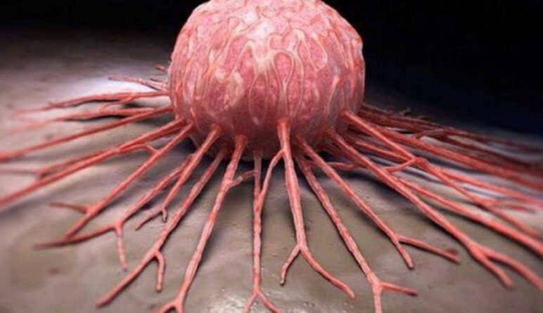 cancer, le cancer, les cellules cancereuses, les causes de cancer, traitement cancer