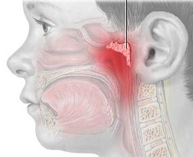 les maladies du nez, ORL, les amygdales, les végétations adénoïdes, les adenoides