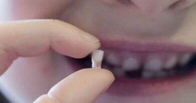 dents de lait, dents de requin, dents permanents,causes dents superposées, extraction dent de lait