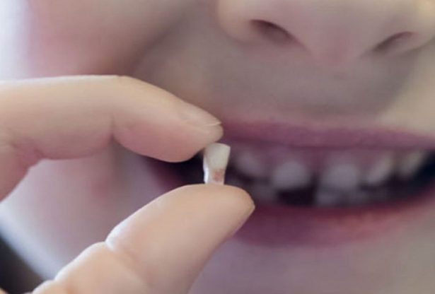 dents de lait, dents de requin, dents permanents,causes dents superposées, extraction dent de lait