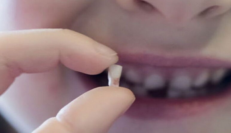 dents de lait, dents de requin, dents permanents,causes dents superposées, extraction dent de lait
