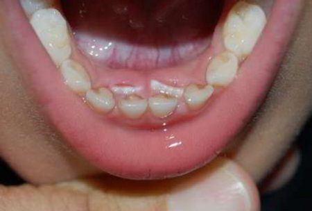 dents de lait, dents de requin, dents permanents,causes dents superposées, extraction dent de lait, plusieurs rangés de dents