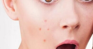 l'acné, maladies de la peau, boutons sur la peau