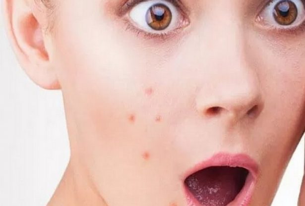 l'acné, maladies de la peau, boutons sur la peau