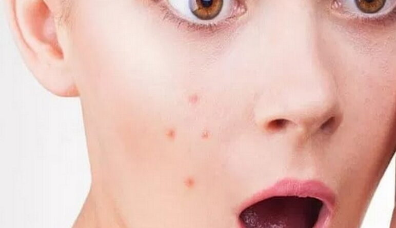 l'acné, maladies de la peau, boutons sur la peau