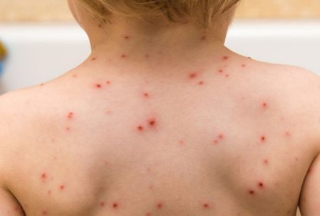 la varicelle, comment traiter la varicelle