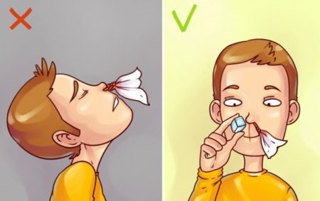 saignement nasal, saignement nez, nez saigne, quoi faire si le nez saigne