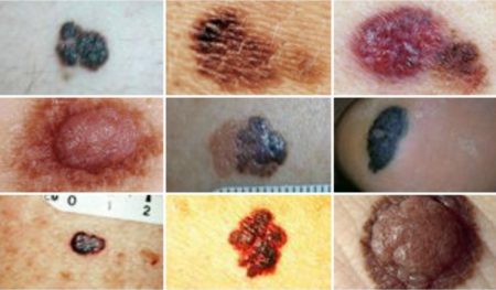 cancer de la peau, le mélanome, le cancer du sein, traitement cancer du sein, comment se protéger du cancer