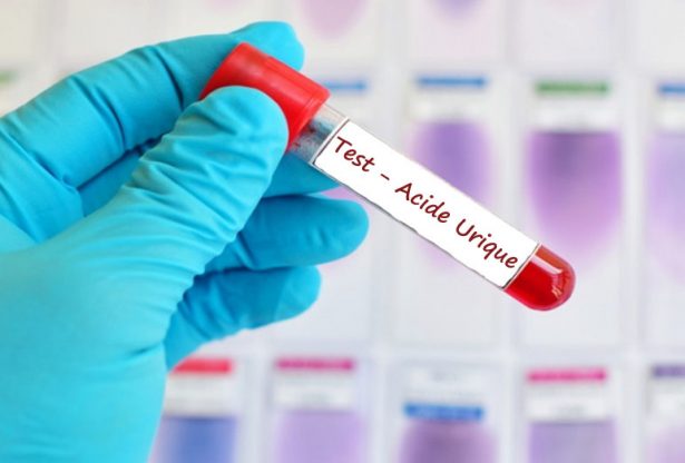 l'acide urique, la goutte, les maladies des articulations, les articulations, mal aux articulations