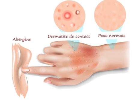 maladies de la peau, la peau, cancer de la peau, la dermatite, les démangeaisons,