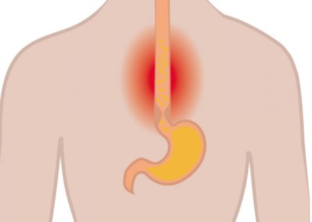 maladies de l'œsophage, l'œsophage, œsophagite, cancer de l'œsophage