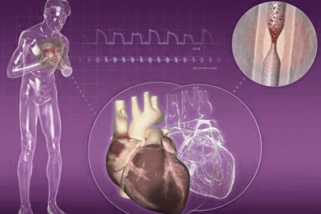 infarctus, infarctus du myocarde, le myocarde, maladies du cœur, athérosclérose,AVC