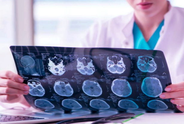 notre cerveau, la santé de notre cerveau