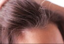 la perte de cheveux, la santé des cheveux