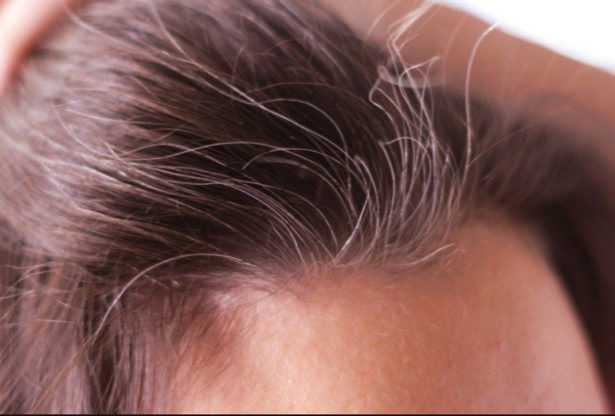 la perte de cheveux, la santé des cheveux
