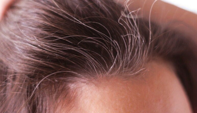 la perte de cheveux, la santé des cheveux
