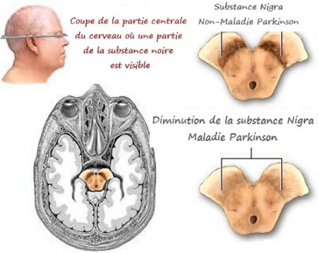 la dopamine, les neurotransmetteurs, la maladie de Parkinson, Parkinson, la démence, traitement de Parkinson, comment traiter Parkinson, la vie avec Parkinson