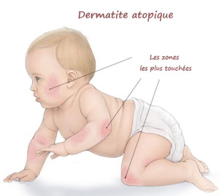 maladies de la peau, la dermatite, éruptions cutanées, les démangeaisons,