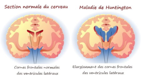 maladie neurologique