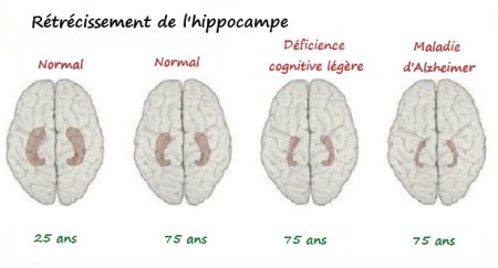 maladie d'Alzheimer, Alzheimer, démence, Parkinson, traitement d'Alzheimer, médicaments Alzheimer