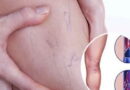 les varices, comment traiter les varices