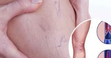 les varices, comment traiter les varices