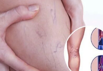 les varices, comment traiter les varices