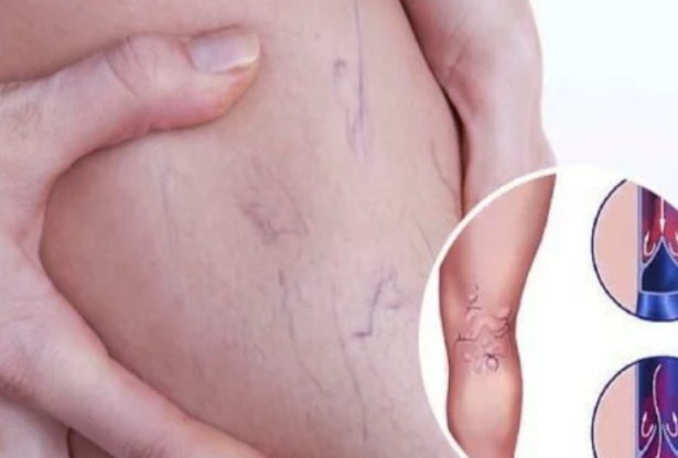 les varices, comment traiter les varices