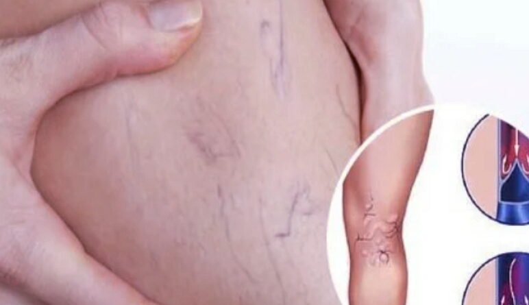 les varices, comment traiter les varices