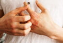 le psoriasis, les causes du psoriasis