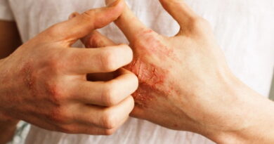 le psoriasis, les causes du psoriasis