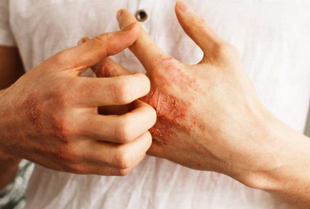 le psoriasis, les causes du psoriasis