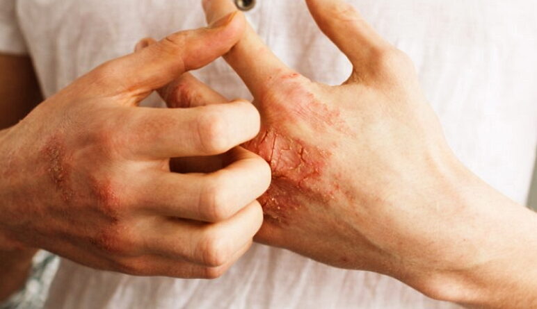 le psoriasis, les causes du psoriasis