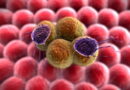 cancer du pancréas, comment traiter le cancer de pancréas