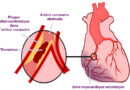 infarctus, infarctus du myocarde