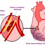 infarctus, infarctus du myocarde