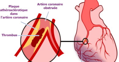 infarctus, infarctus du myocarde