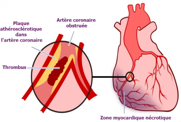 infarctus, infarctus du myocarde