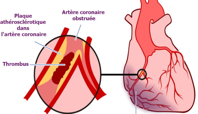 infarctus, infarctus du myocarde