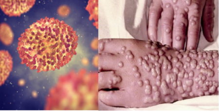 coronavirus, SRAS, Grippe, virus, maladies infectieuses, covid-19, covid, choléra, Ébola