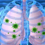 maladies des poumons, pneumonie, les signes de la pneumonie, symptômes de la pneumonie, traitement de la pneumonie, tout sur la pneumonie