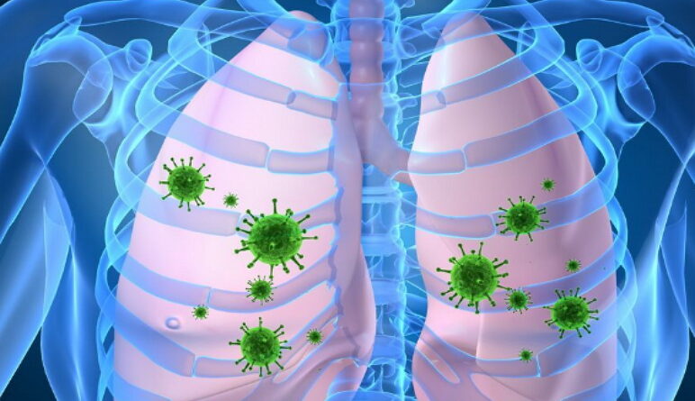 maladies des poumons, pneumonie, les signes de la pneumonie, symptômes de la pneumonie, traitement de la pneumonie, tout sur la pneumonie