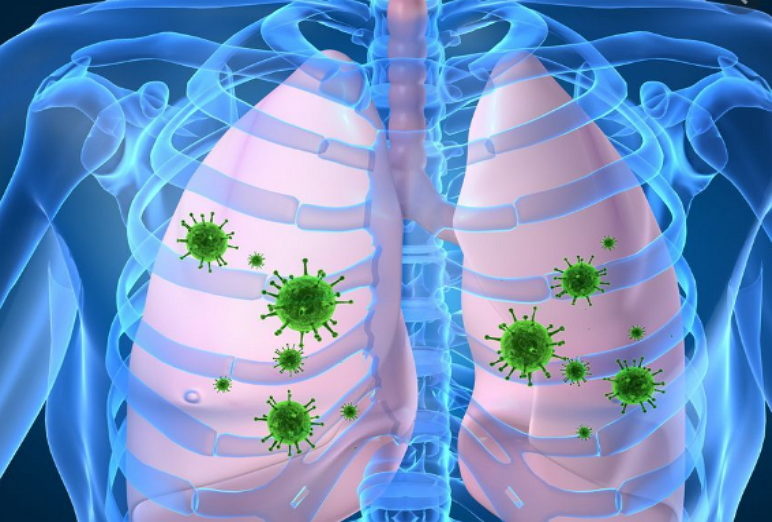 maladies des poumons, pneumonie, les signes de la pneumonie, symptômes de la pneumonie, traitement de la pneumonie, tout sur la pneumonie