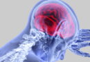 AVC, maladies cardiaques, maladies du cœur, accident vasculaire cérébral, maladies neurologiques,