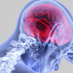 AVC, maladies cardiaques, maladies du cœur, accident vasculaire cérébral, maladies neurologiques,