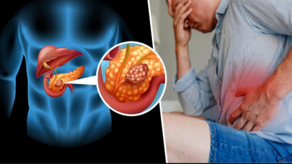 cancer de pancréas, le pancréas, comment se protéger de cancer