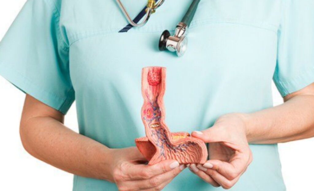 tout sur le cancer de l'œsophage