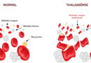 Thalassémie : graves conséquences d&rsquo;une petite mutation
