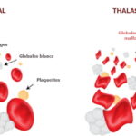 Thalassémie : graves conséquences d&rsquo;une petite mutation