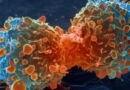 10 aliments liés à un risque accru de cancer : ce que vous devez savoir